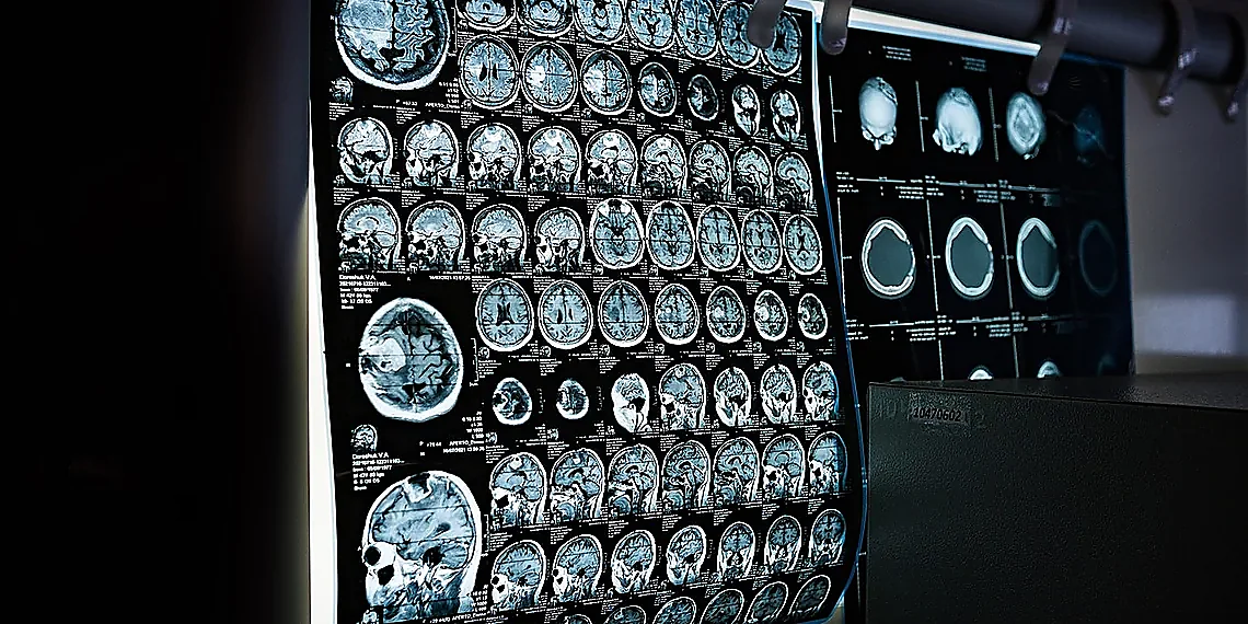 Limitations in Contrast & Detail – X-ray imaging